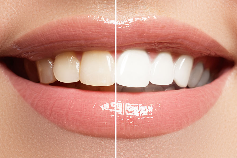5 Best Teeth Whitening Pens for a Radiant Smile